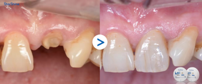 zirconia milling blanks